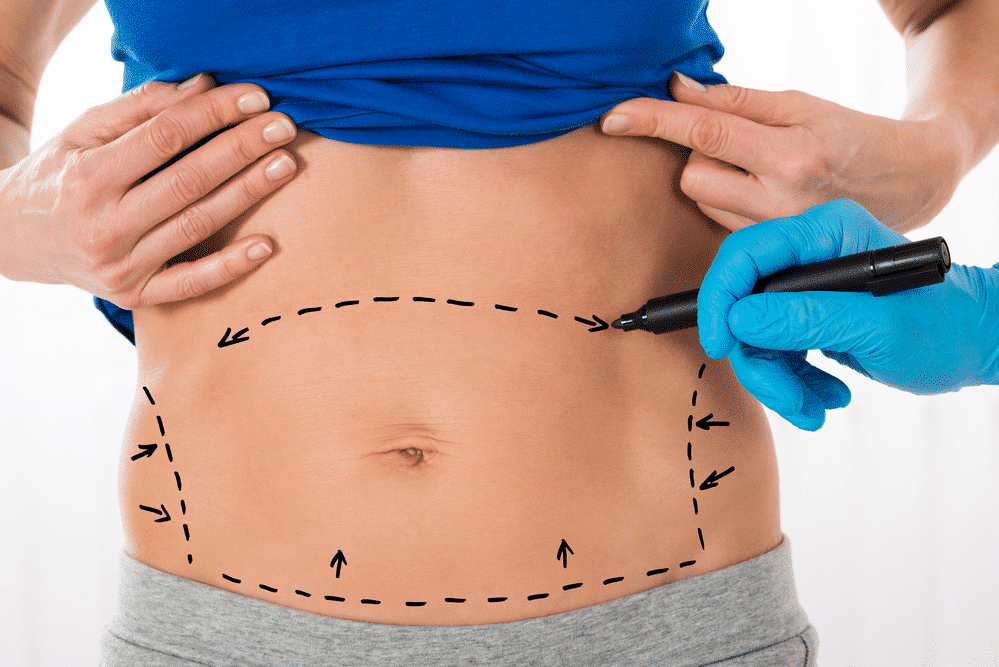 What's the Potential Weight Loss after Tummy Tuck?