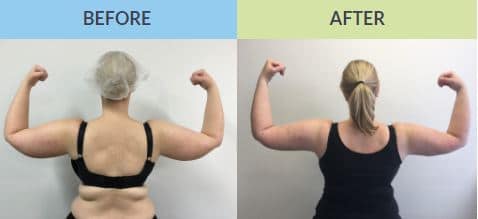 arms liposuction sydney