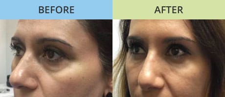 Tear Trough Fillers before after
