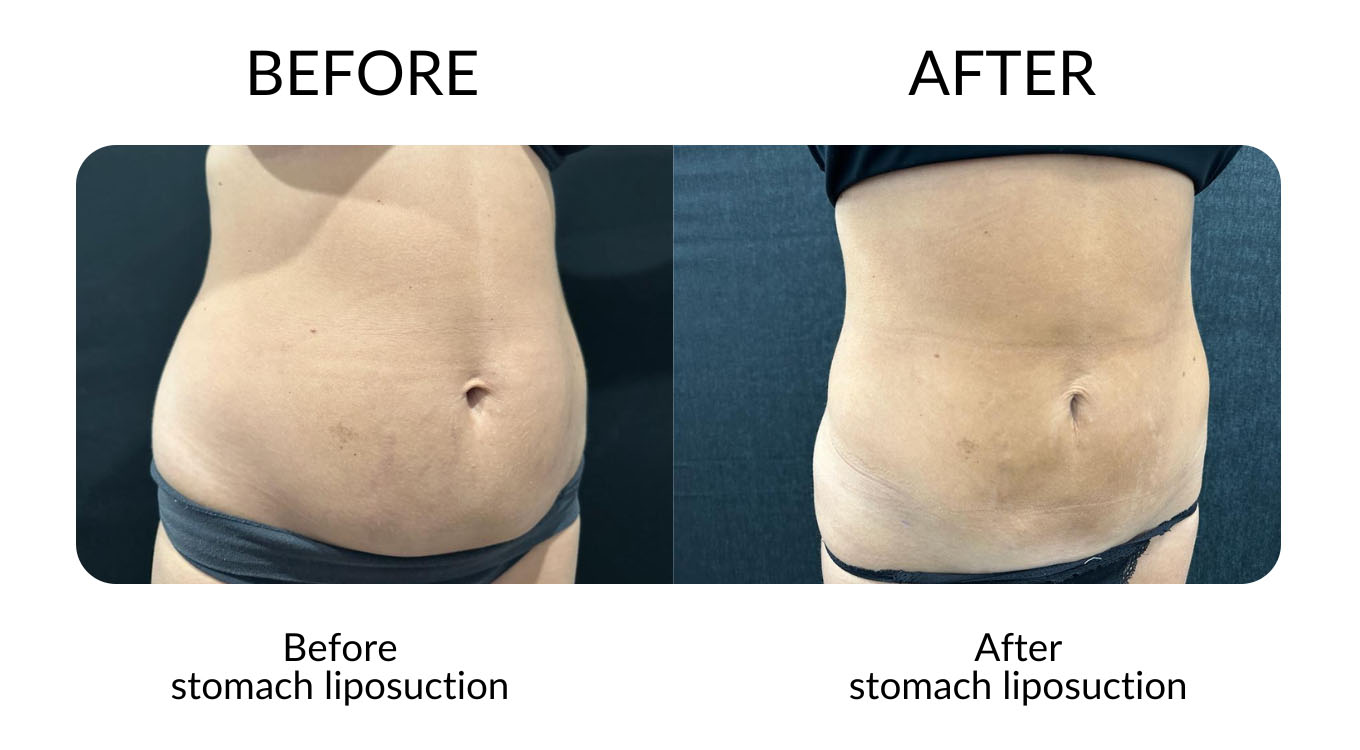 Liposuction Before And After Gallery - MCC Sydney