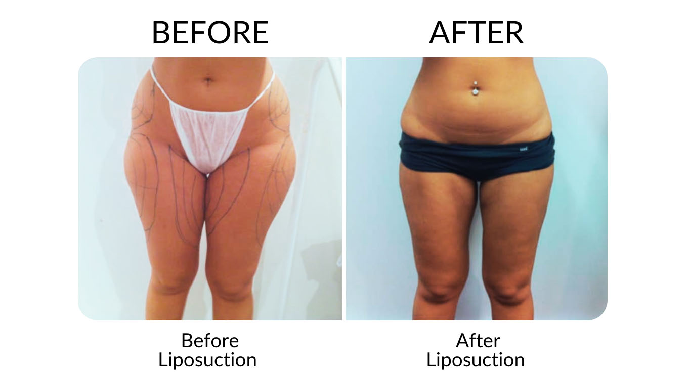 Liposuction Before And After Gallery - MCC Sydney