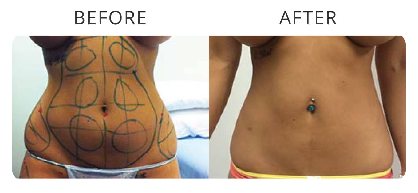 abdomen liposuction before after