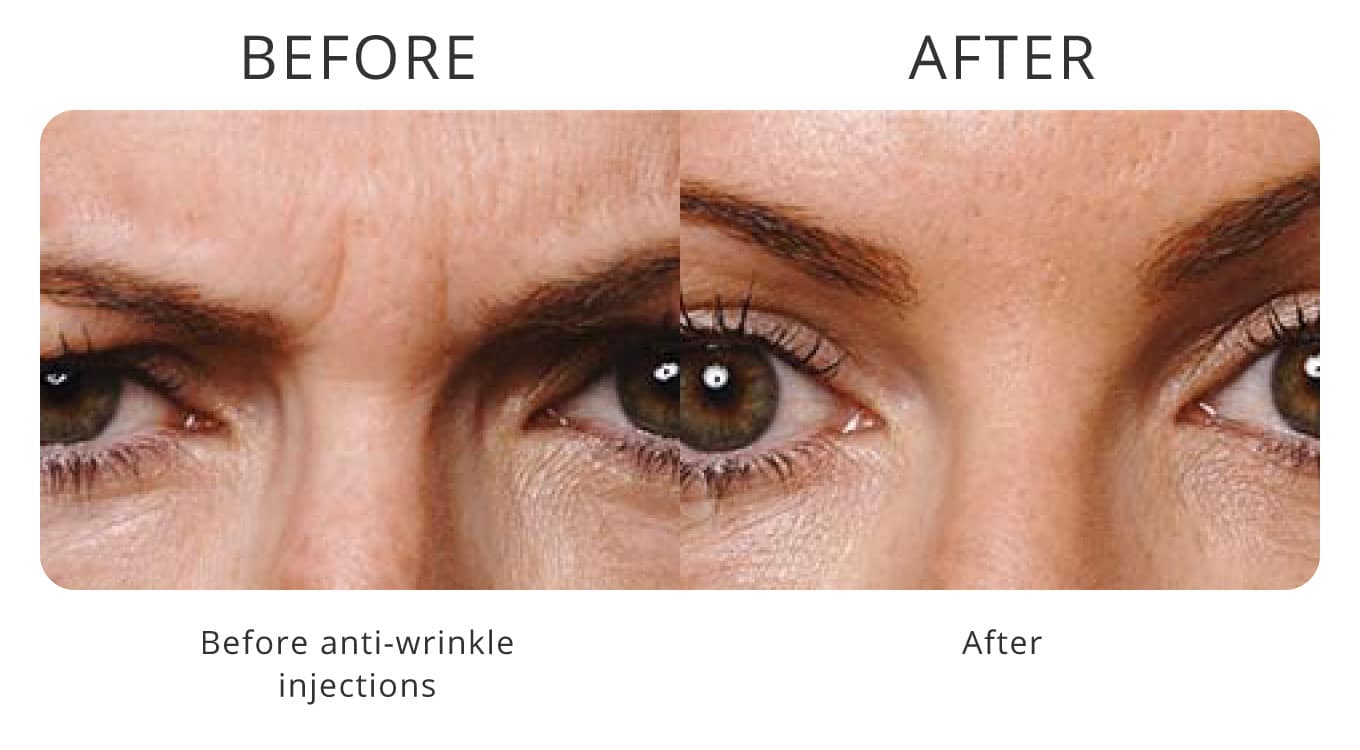 anti-wrinkle injections before after