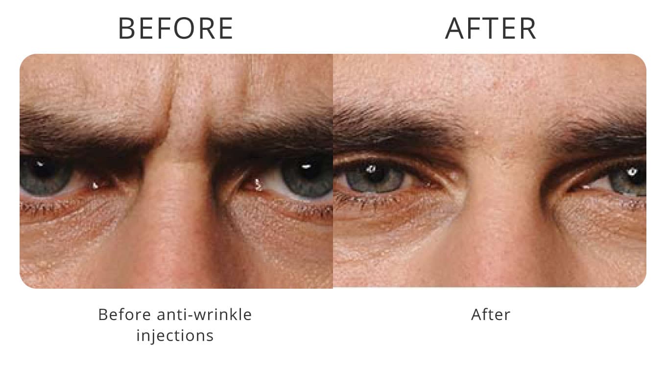 anti-wrinkle injections before after