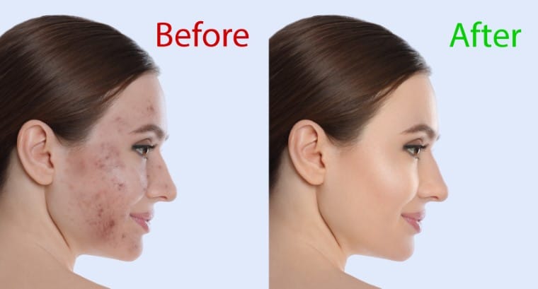 chemical peel before after