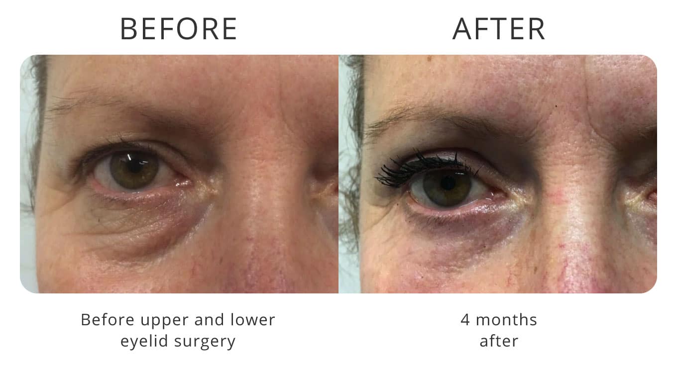 eyelid surgery before after