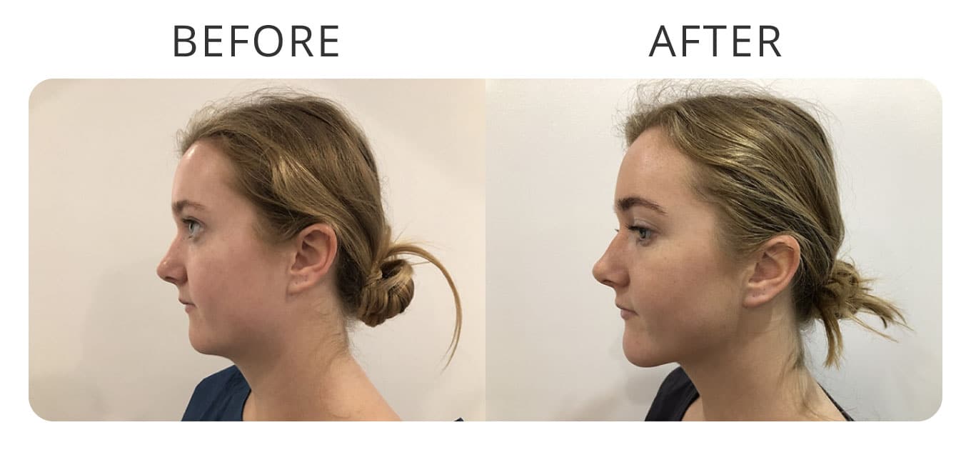 face neck chin liposuction before afte