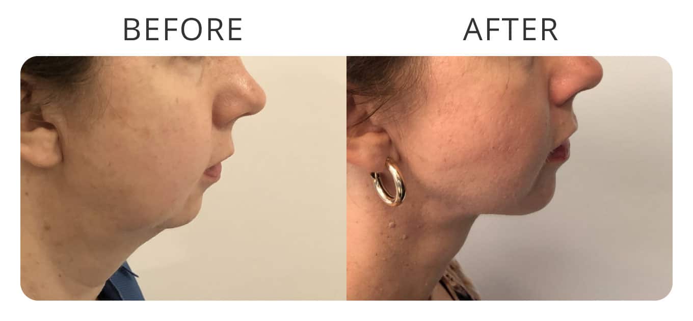 face neck chin liposuction before afte