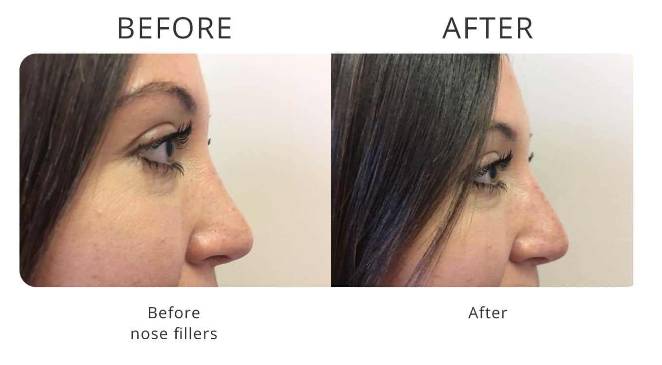 nose fillers before after