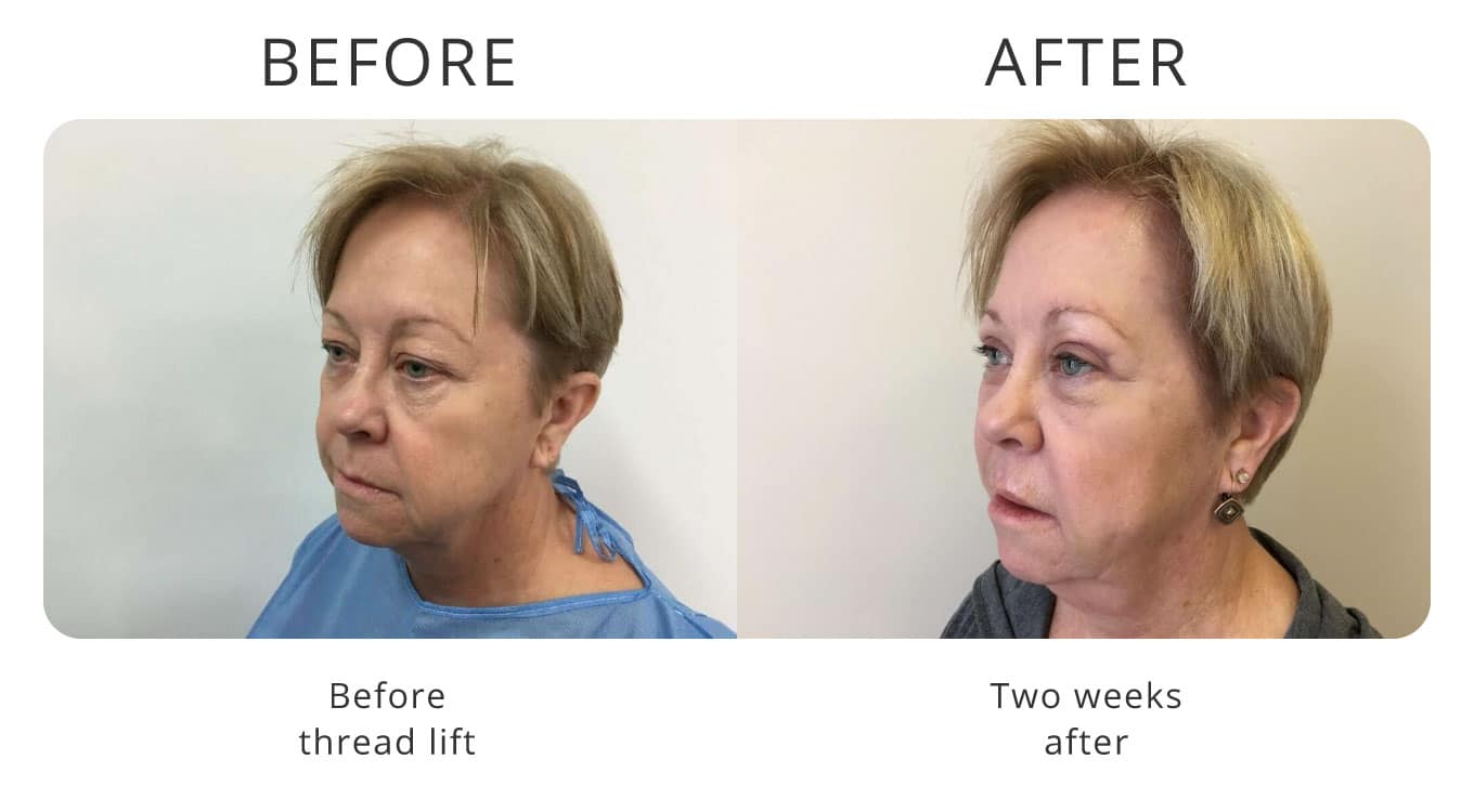 thread lift before after