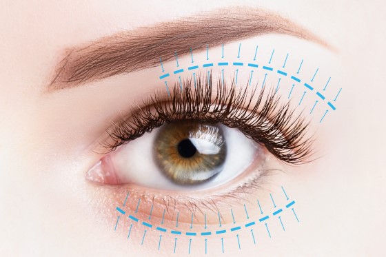 eyelid surgery in wollongong - My Cosmetic Clinic