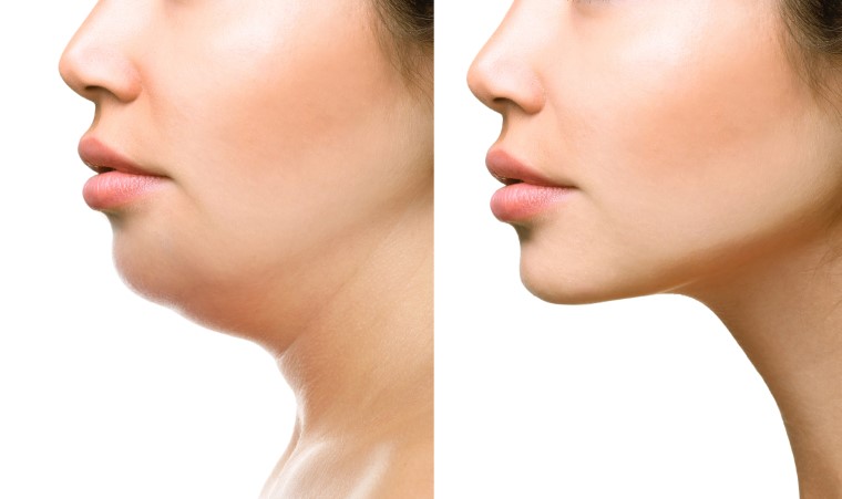 what is the best procedure to get rid of a double chin My Cosmetic Clinic