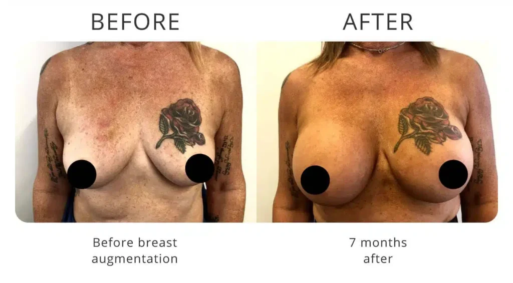 breast-augmentation-before-after-1.jpg