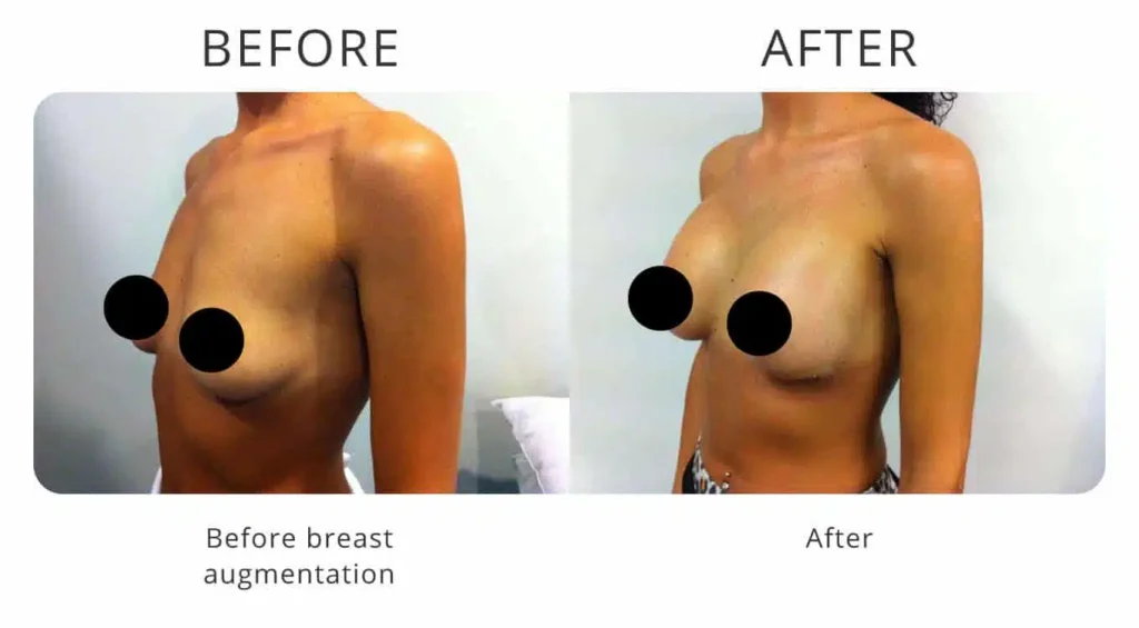 breast-augmentation-before-after-10.jpg