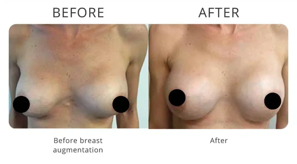 breast-augmentation-before-after-2.jpg