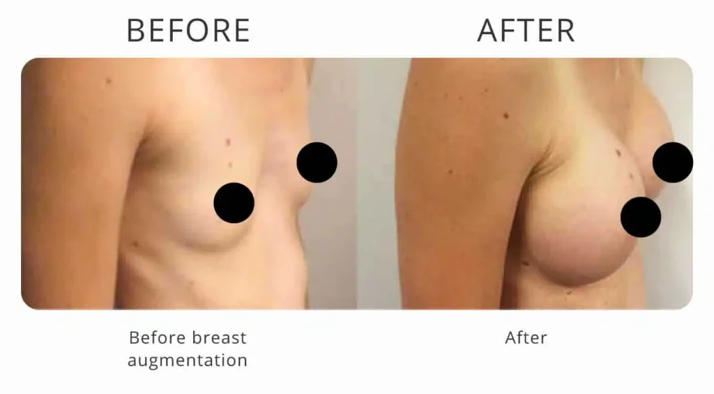 breast-augmentation-before-after-3.jpg