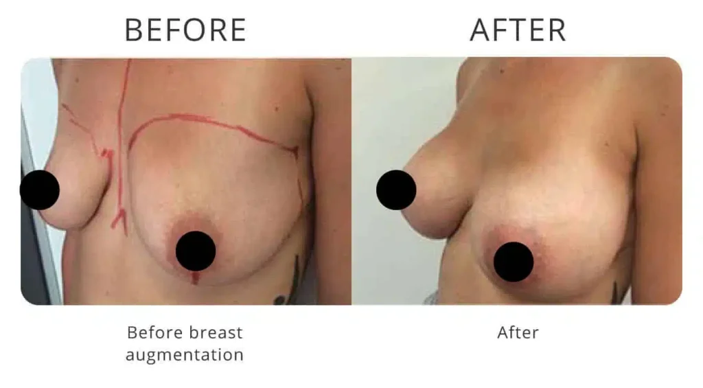 breast-augmentation-before-after-4.jpg