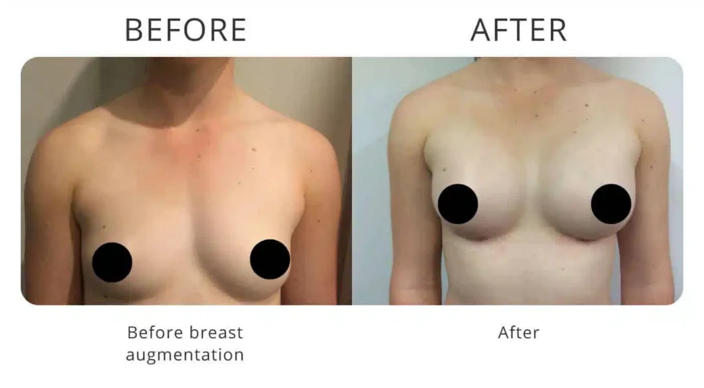 breast-augmentation-before-after-5.jpg