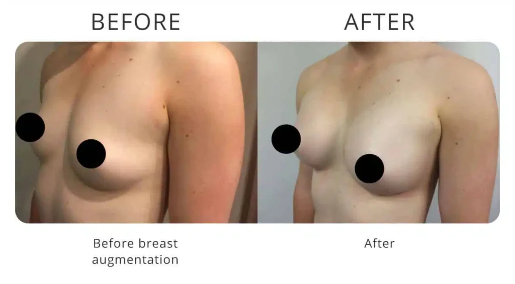 breast-augmentation-before-after-6.jpg
