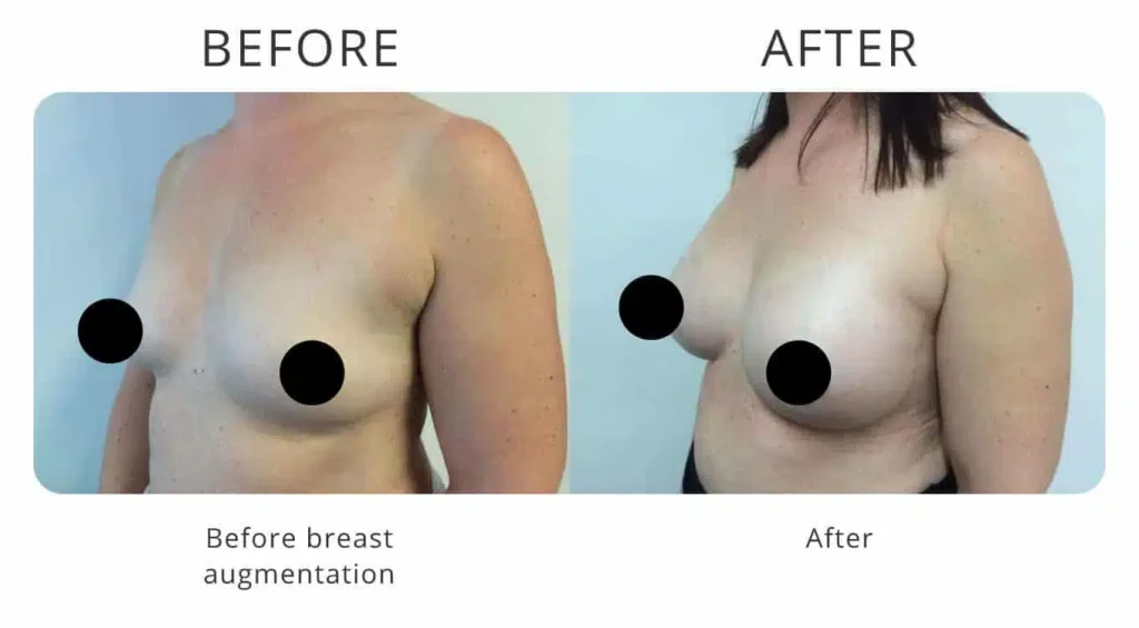 breast-augmentation-before-after-7.jpg