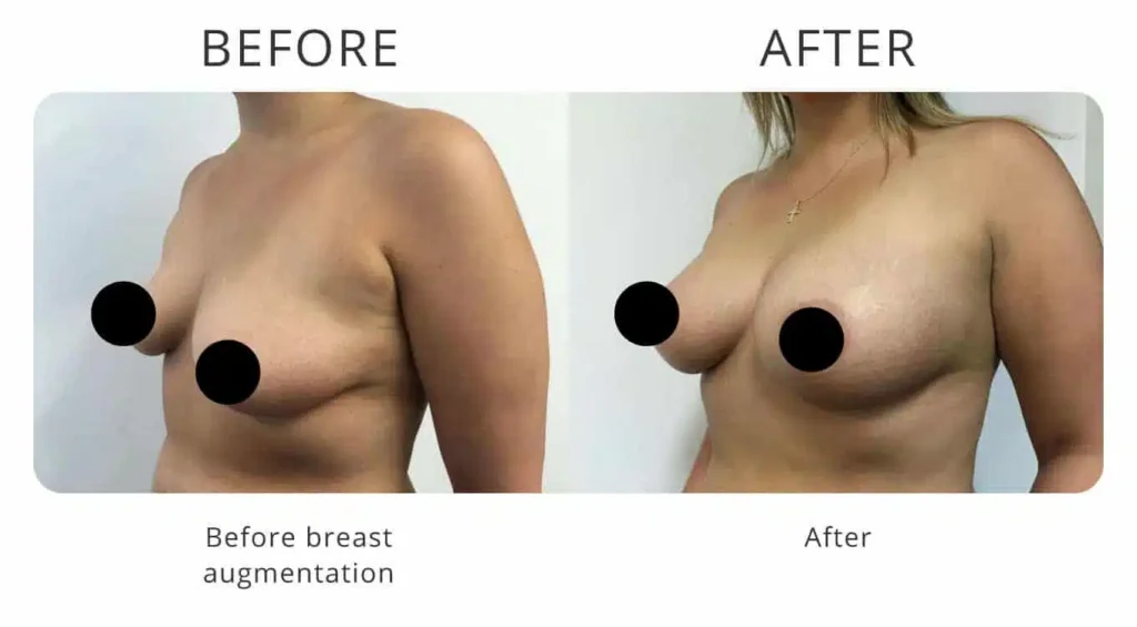 breast-augmentation-before-after-8.jpg