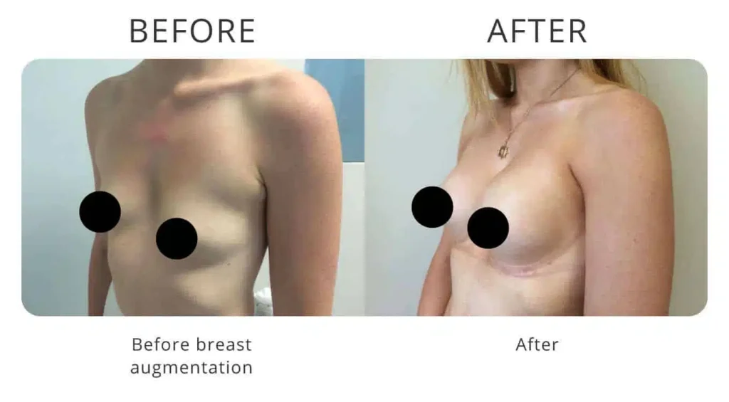 breast-augmentation-before-after-9.jpg
