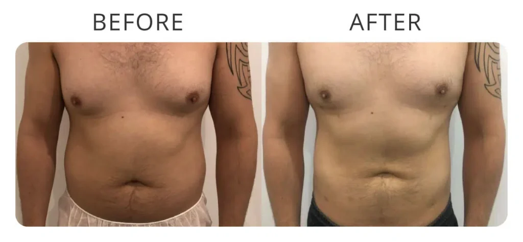 love-handles-liposuction-before-after-3-1.jpg