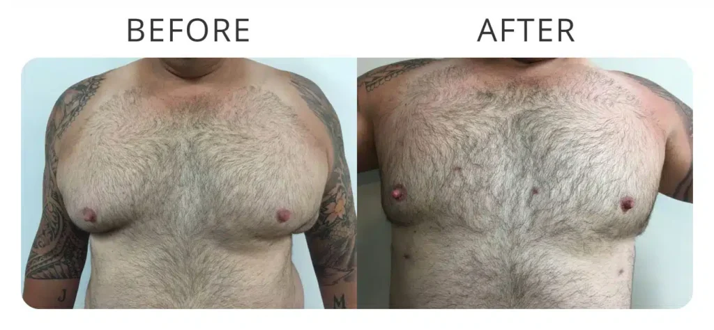male-breast-reduction-before-after-2.jpg