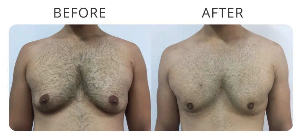 male-breast-reduction-before-after-3.jpg