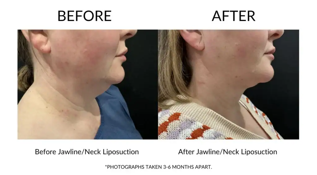 Before and after jawline and neck liposuction results at My Cosmetic Clinic.