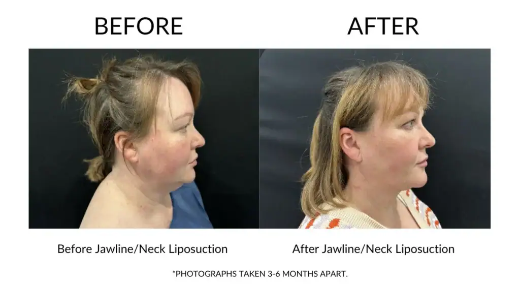 Before and after jawline and neck liposuction results at My Cosmetic Clinic.