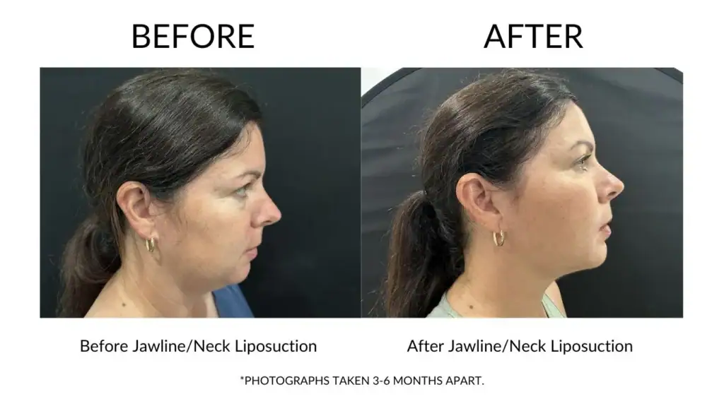Before and after jawline and neck liposuction at My Cosmetic Clinic showing improved profile.