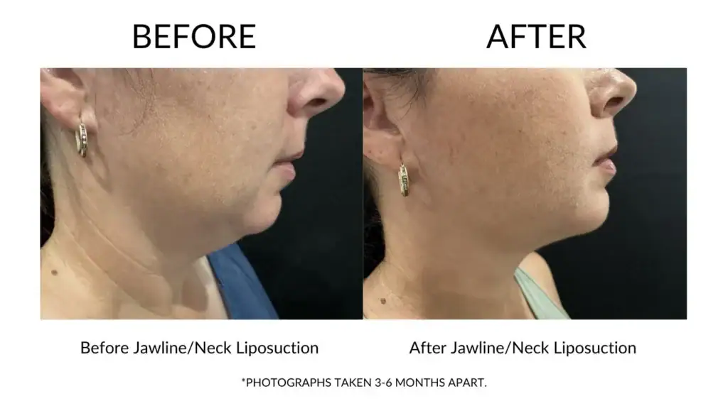 Before and after jawline and neck liposuction results at My Cosmetic Clinic.