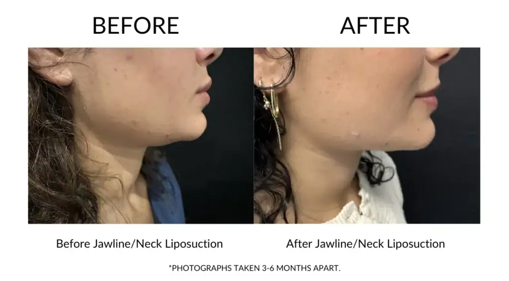 Before and after jawline and neck liposuction results at My Cosmetic Clinic.