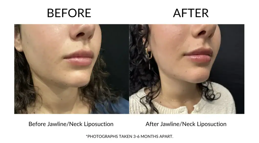 Before and after jawline and neck liposuction results at My Cosmetic Clinic.