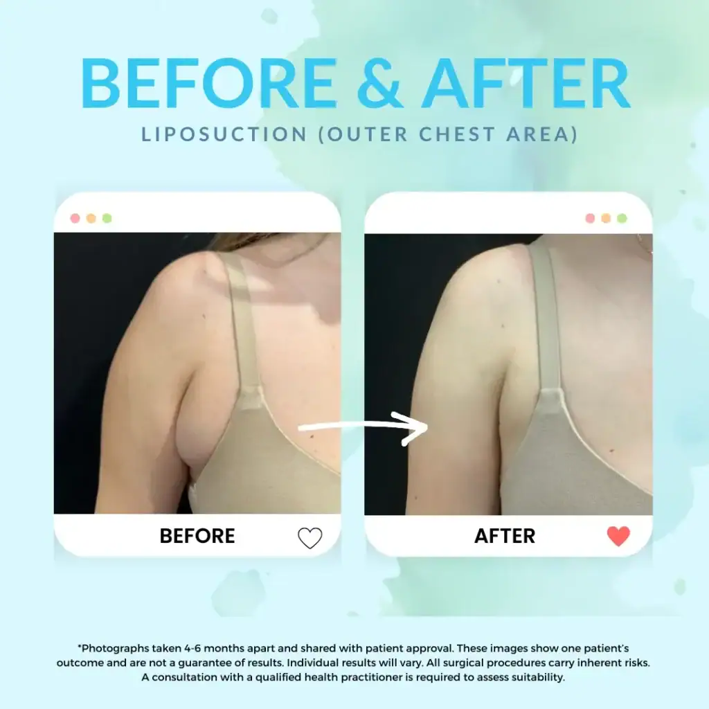 Liposuction Sydney