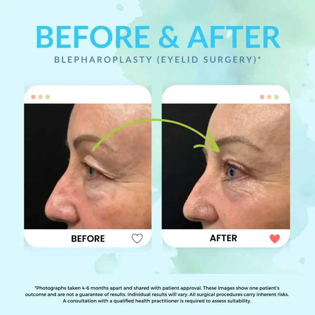 Before and after upper eyelid surgery