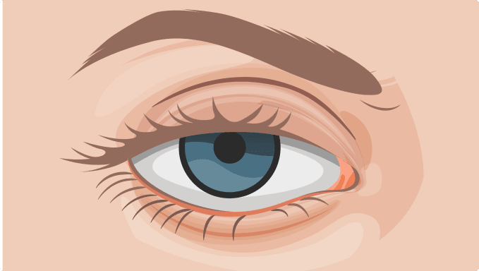 Blepharoplasty in Sydney