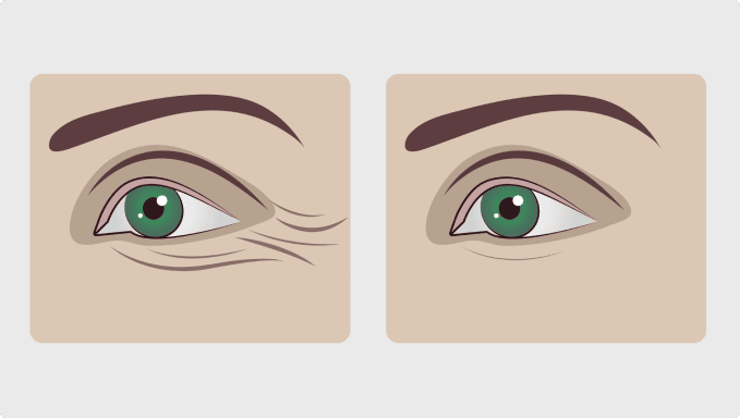 Blepharoplasty surgery in Sydney