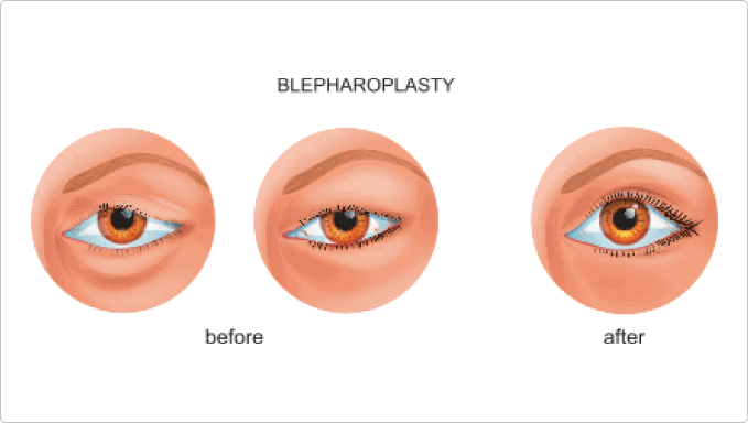 Blepharoplasty surgery Sydney