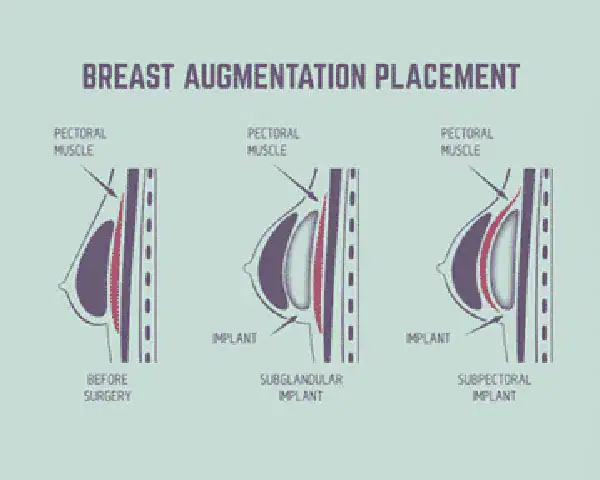 Breast augmentation placement Sydney