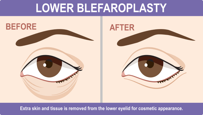 Lower eyelid surgery Sydney