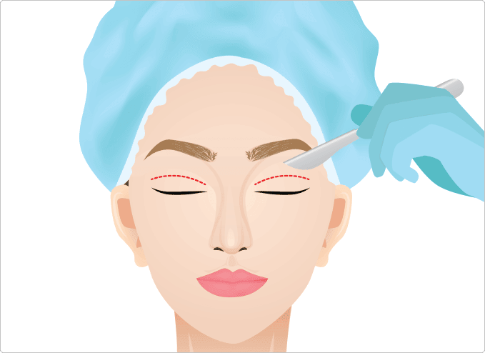 Sydney lower eyelid surgery