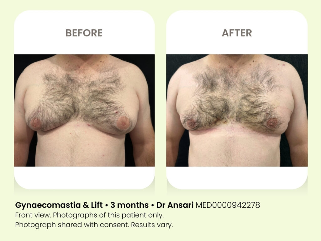 Chest surgery for men. Gynaecomastia cosmetic liposuction. Sydney.