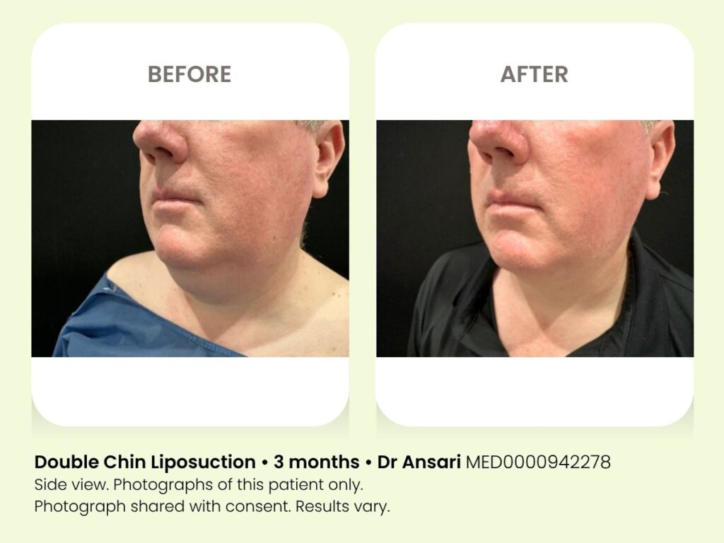 Before and after double chin liposuction at My Cosmetic Clinic, 3 months post-procedure.