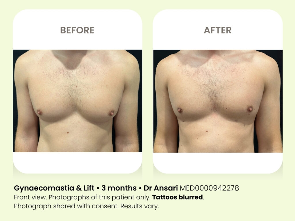 Chest surgery for men. Gynaecomastia cosmetic liposuction. Sydney.