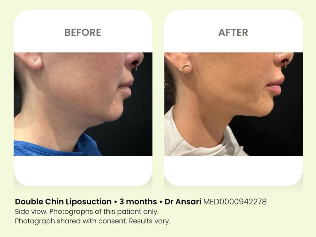 Before and after double chin liposuction at My Cosmetic Clinic, 3 months post-procedure.