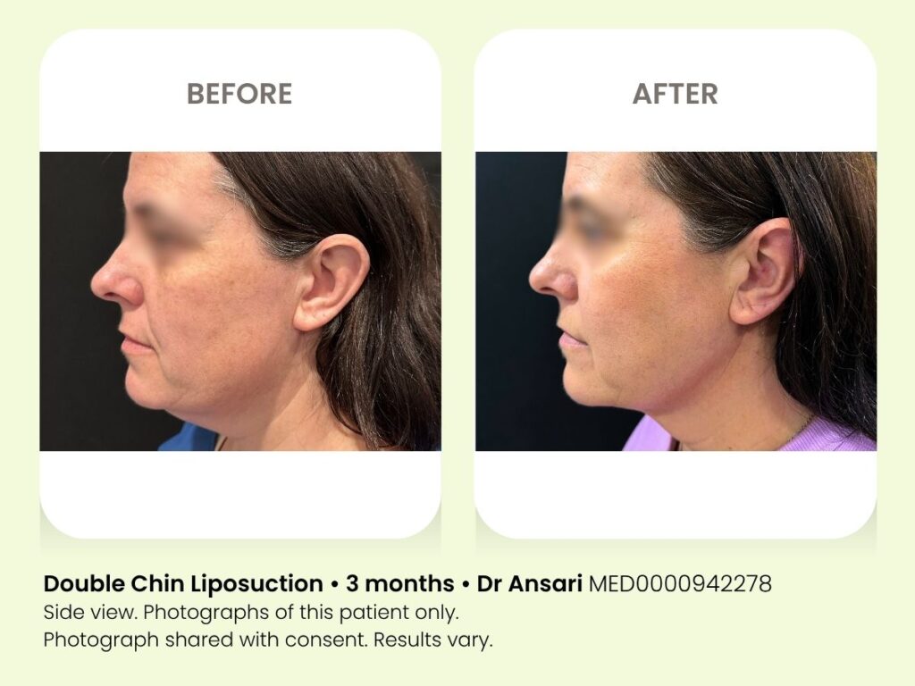 Before and after double chin liposuction at My Cosmetic Clinic, 3 months progress.