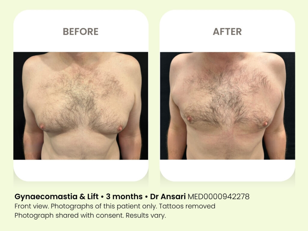 Chest surgery for men. Gynaecomastia cosmetic liposuction. Sydney.