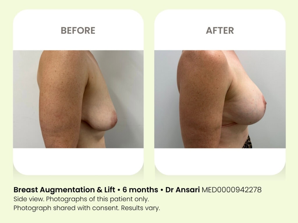 Breast augmentation before and after photos at My Cosmetic Clinic showing improved volume.